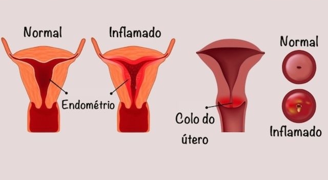 Inflamação no colo do útero pode resultar em corrimento marrom